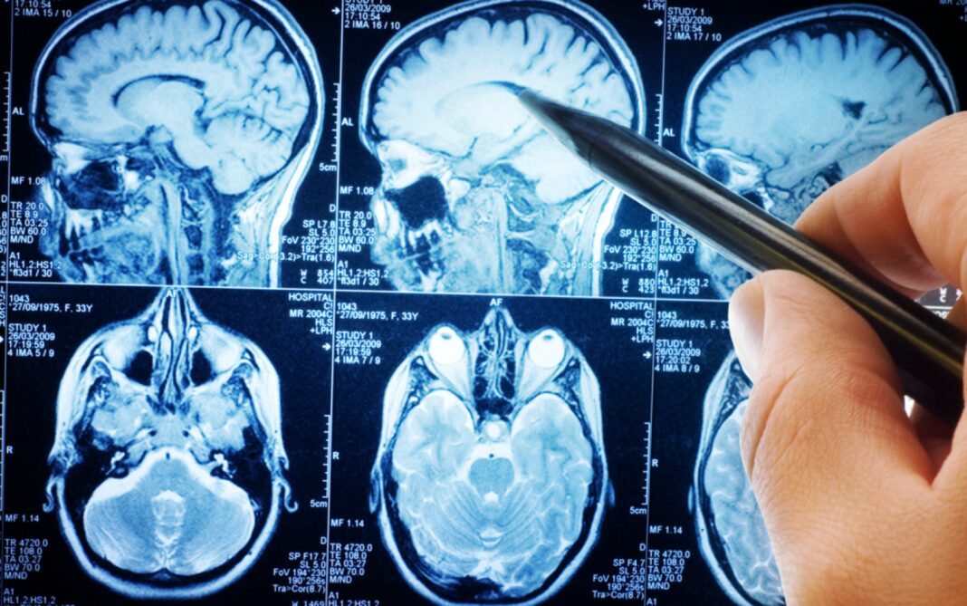 Cercetătorii descoperă o cauză surprinzătoare a hipertensiunii: creierul, nu dieta sau stresul