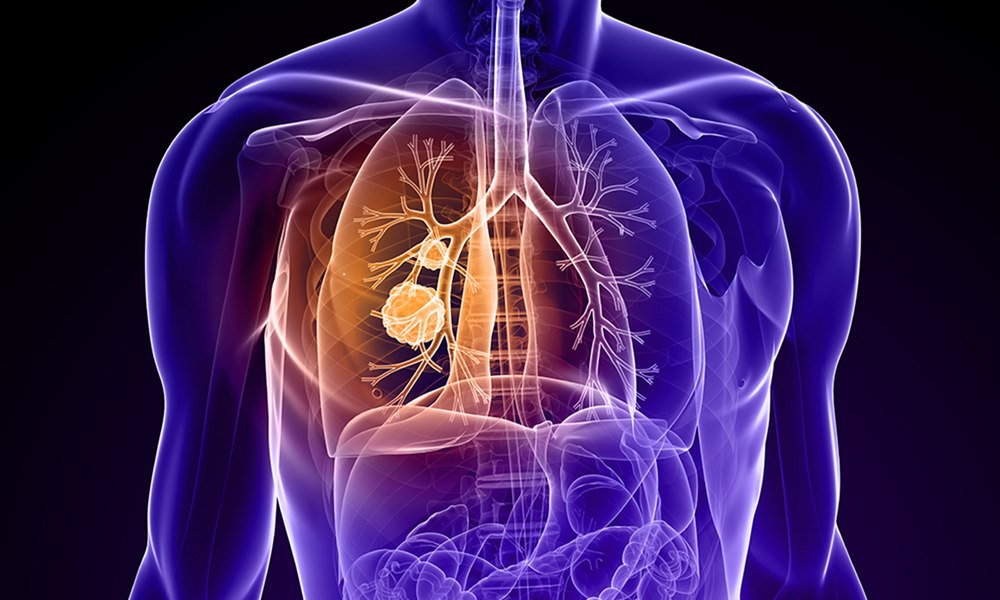 Cum poate fi prevenit cancerul: strategii susținute de cercetare și dovezi științifice
