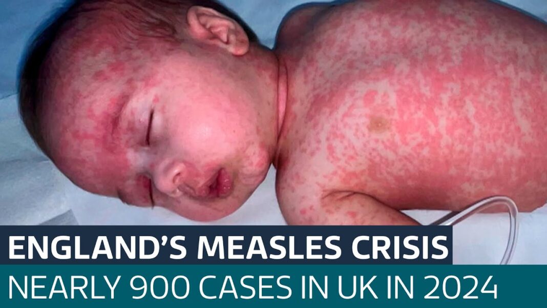 Marea Britanie și-a pierdut statutul de eliminare a rujeolei, a anunțat Organizația Mondială a Sănătății