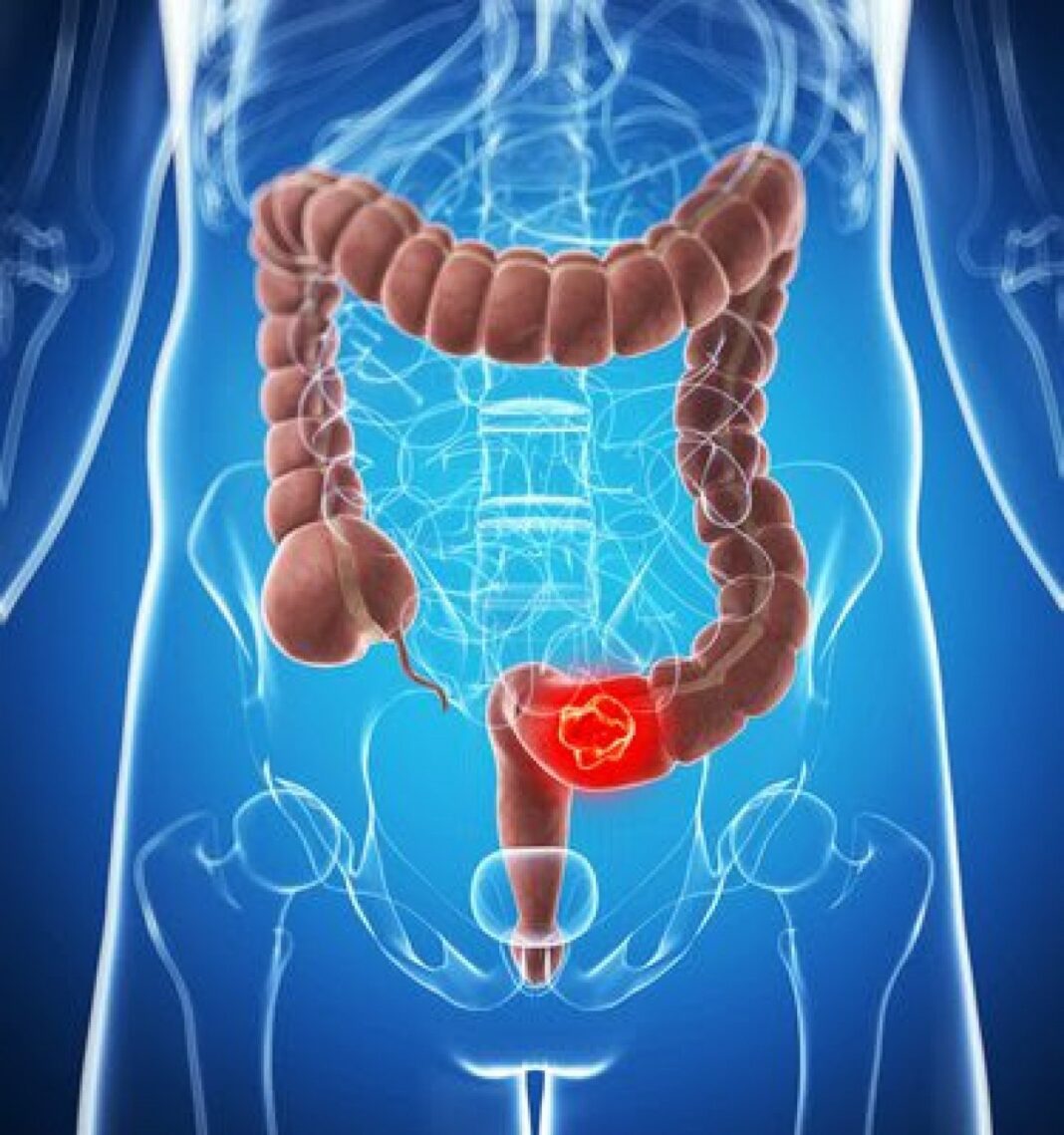 NEWS.ro: Un virus nou descoperit în intestin, asociat cu cancerul colorectal