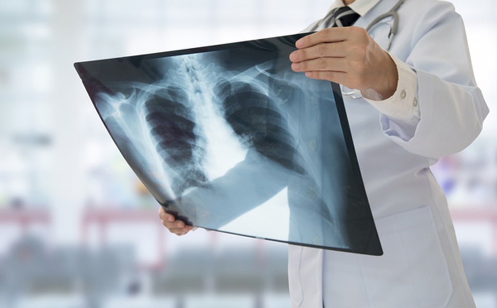Un pacient a fost menținut în viață, fără plămâni, timp de 48 de ore. Inovația chirurgilor a condus la recuperarea sa totală