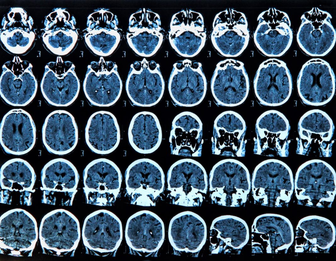  Aproape un milion de români au boli neurologice rare / Se estimează că 1% din populaţie are o formă de epilepsie