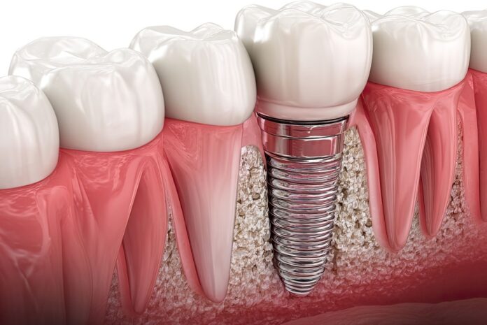 Când pacientul caută o restaurare care să combine protecția cu aspectul natural