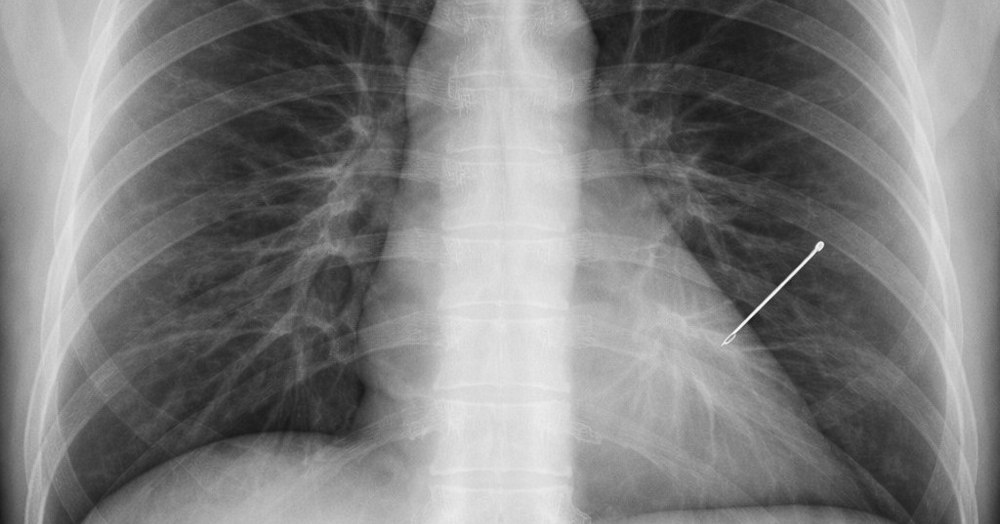 Caz uluitor. O femeie a trăit 30 de ani cu un ac în plămân fără să știe. Descoperirea care l-a șocat pe un reputat medic: „Am înghețat”