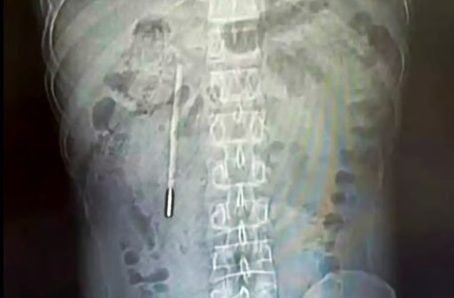 Ce au găsit medicii în stomacul unui bărbat: secretul păstrat 20 de ani