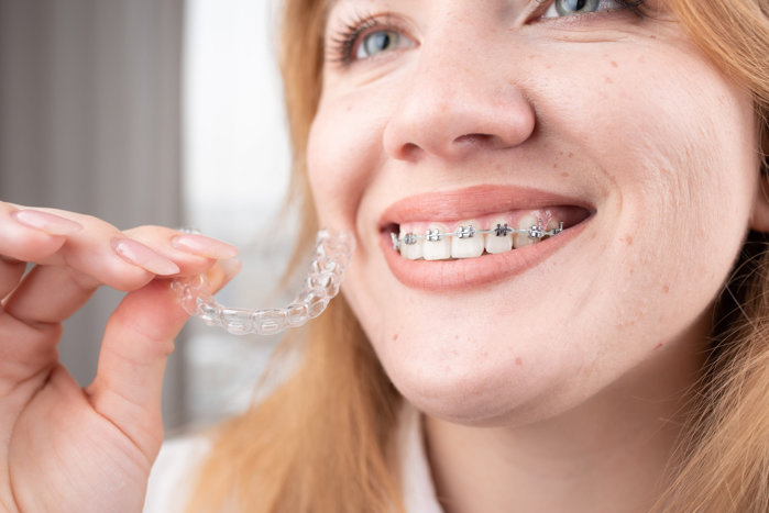 Mai mult decât un zâmbet: de la o simplă necesitate la un nou trend, de ce aparatul dentar a cucerit tot mai mulţi tineri