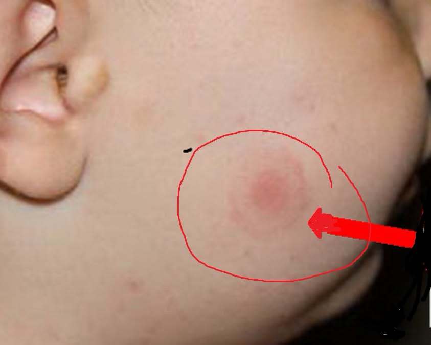 NEWS.ro: Medicul Tudor Ciuhodaru: Vine sezonul căpuşelor / Fiţi atenţi la apariţia oricărui simptom neobişnuit / Zeci de pacienţi au ajuns deja la urgenţe / Când este obligatorie vizita la medic