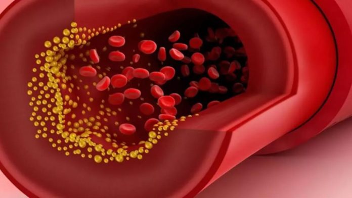 Noi reguli privind colesterolul rău în SUA. Medicii recomandă intervenție mai rapidă pentru prevenirea bolilor de inimă