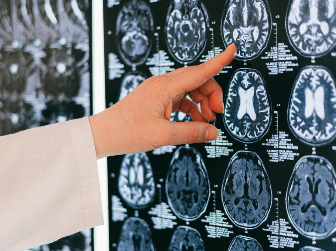 Un implant cerebral pentru depresie va fi testat pe oameni / ”Depresia rezistentă la tratament este una dintre principalele cauze de dizabilitate și suicid”