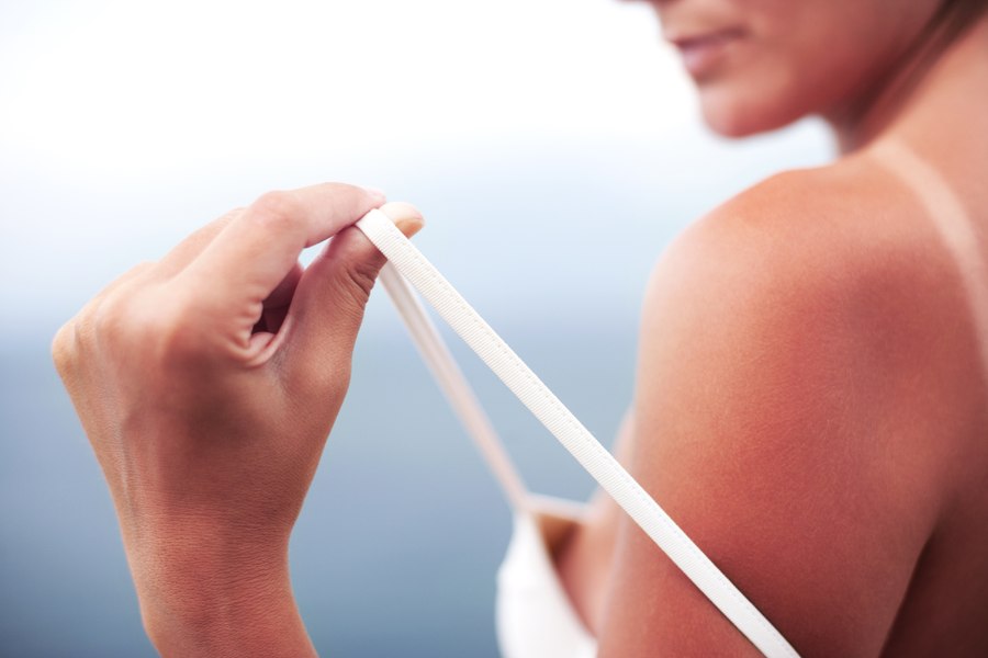 Nu toate arsurile solare sunt la fel. Unele pot dubla riscul de cancer