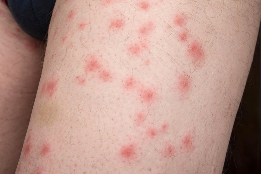 Caz extrem de infestare cu ploșnițe. „Cel mai grav caz din cariera mea”, spune un specialist cu 38 de ani de experiență