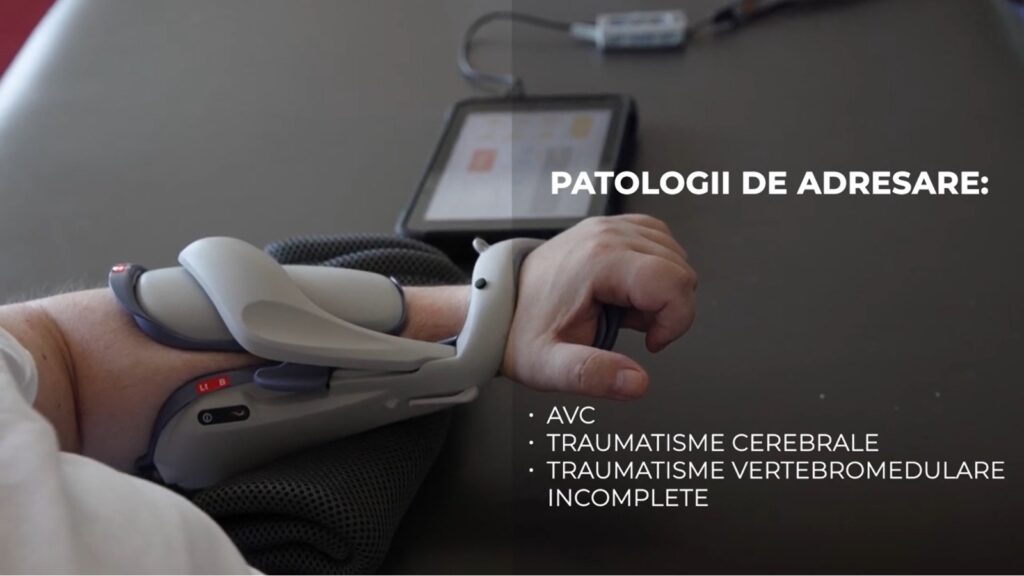 Orteza care ajută pacienții să reînvețe să își miște mâna paralizată în urma AVC sau a unor traumatisme ale coloanei vertebrale